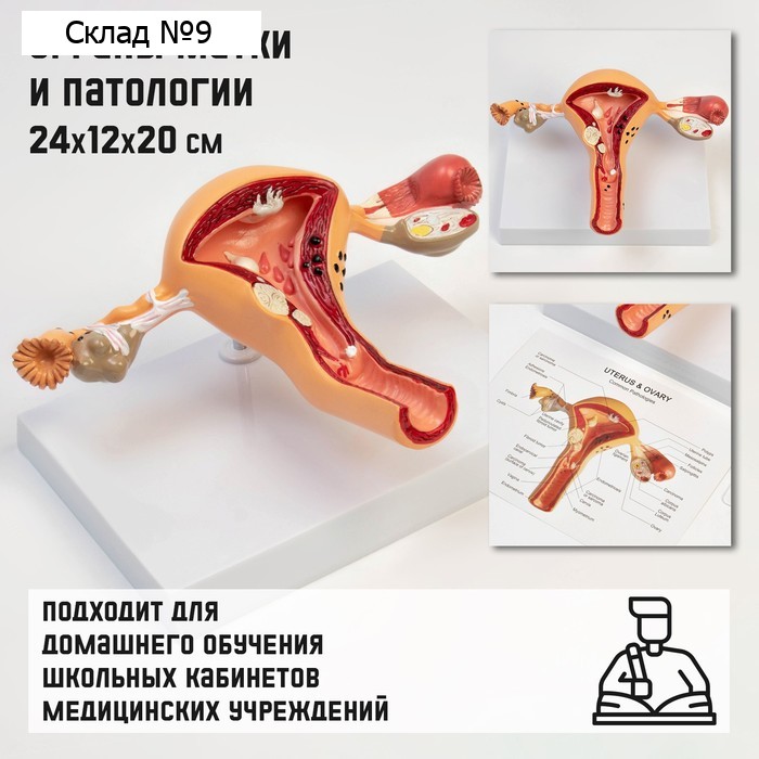 Анатомическая модель «Макет матки с патологиями», 24×12×20 см